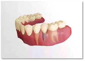 Multiple teeth implant