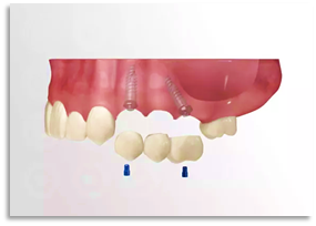 One tooth implant
